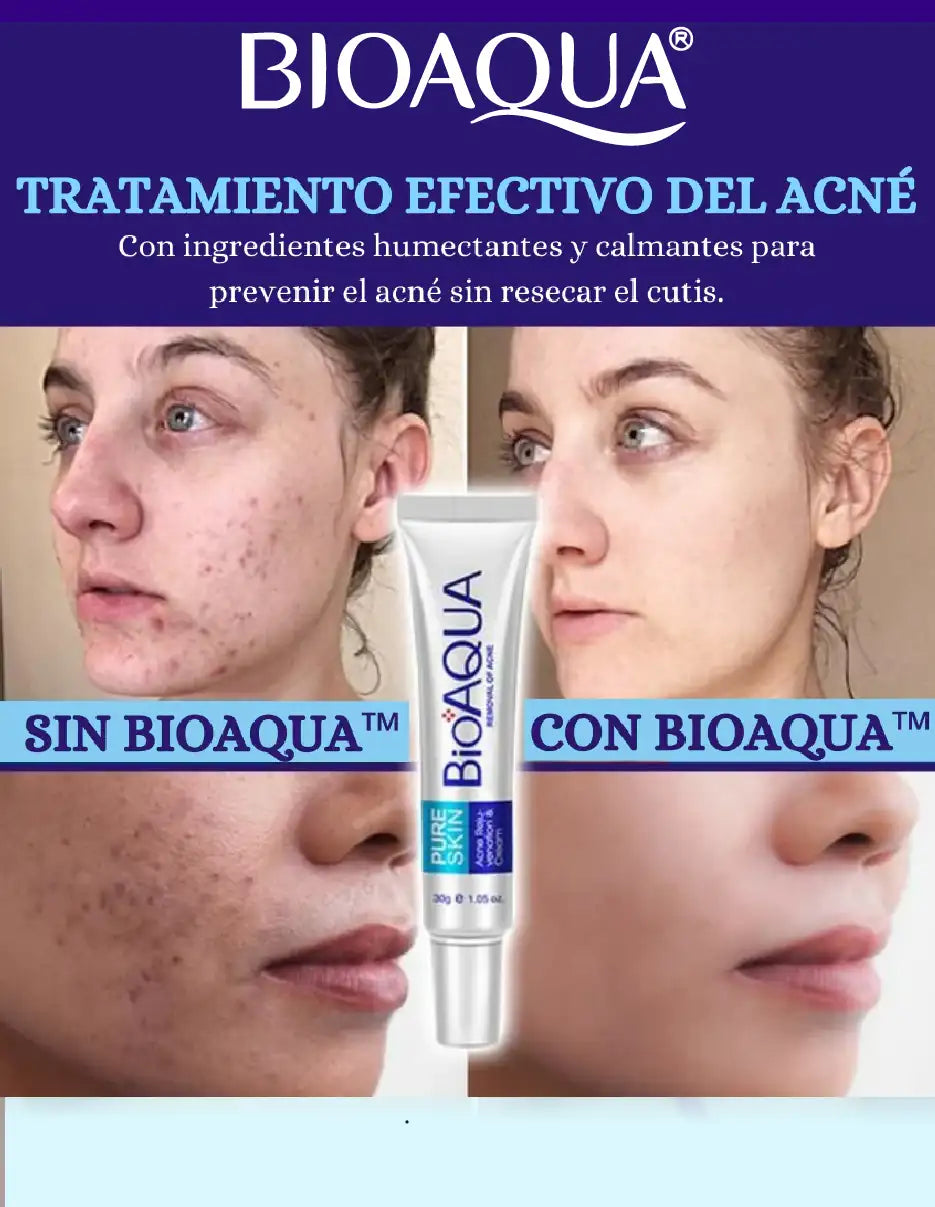 CREMA ANTI ACNE BIOAQUA [PV1-TIKTOK-IMPORTSGUATE]
