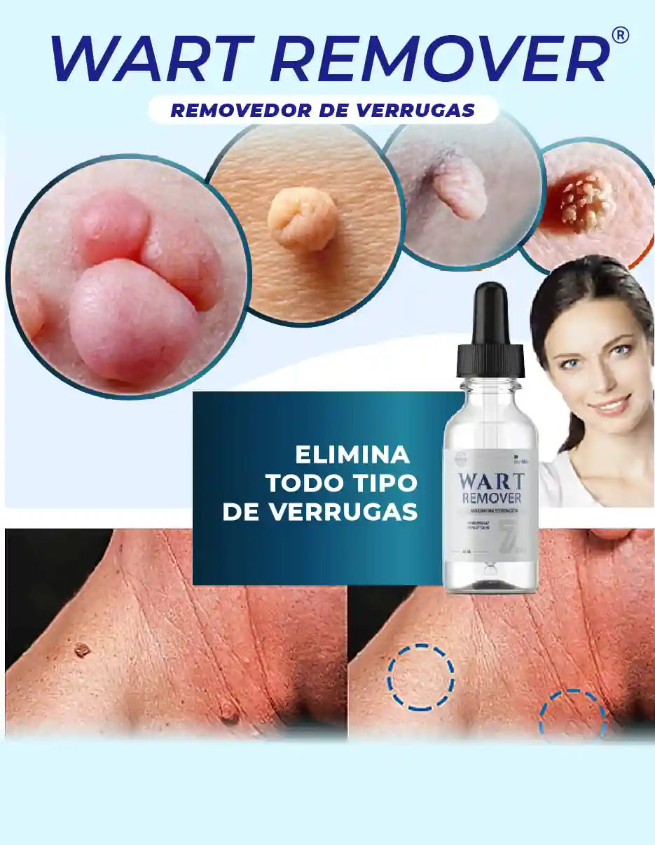 REMOVEDOR DE VERRUGAS WART REMOVER [PV1-META-IMPORTSGUATE]