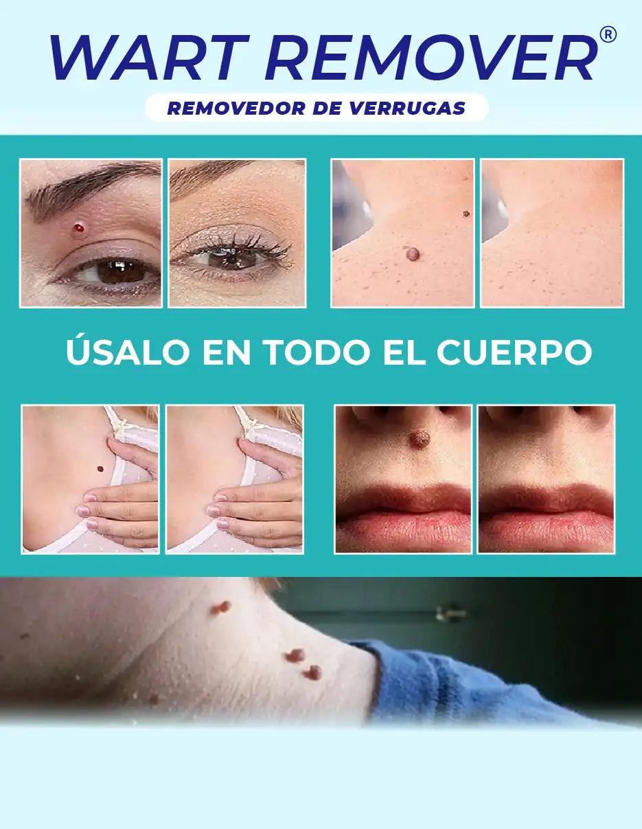 REMOVEDOR DE VERRUGAS WART REMOVER [PV1-TIKTOK-IMPORTSGUATE]